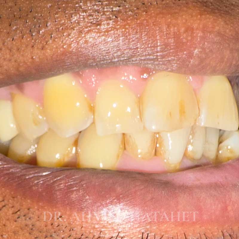 After dental treatment