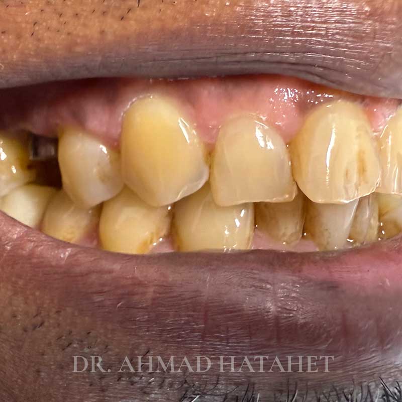 Before dental treatment