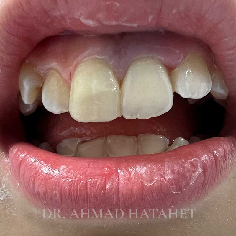 After dental treatment