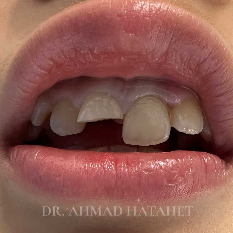 Before dental treatment