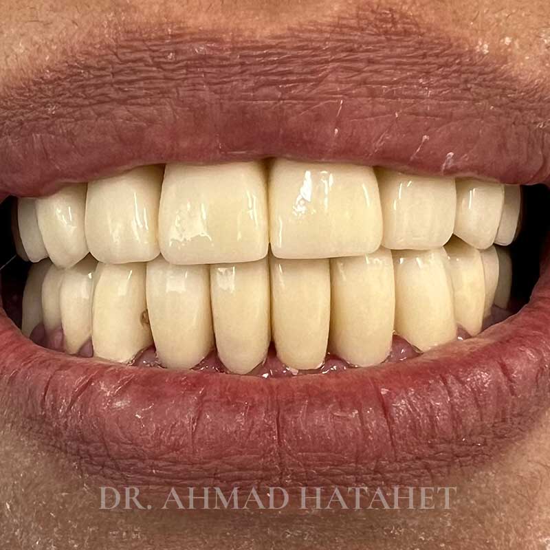 After dental treatment