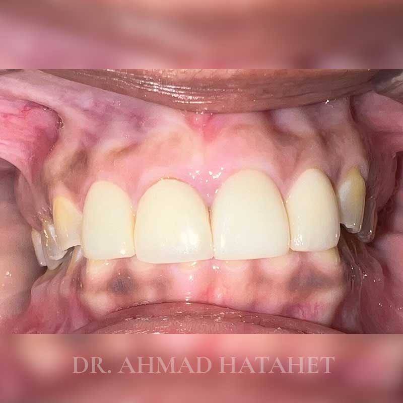 Before dental treatment