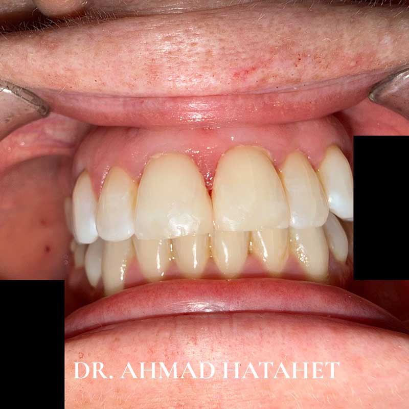 After dental treatment