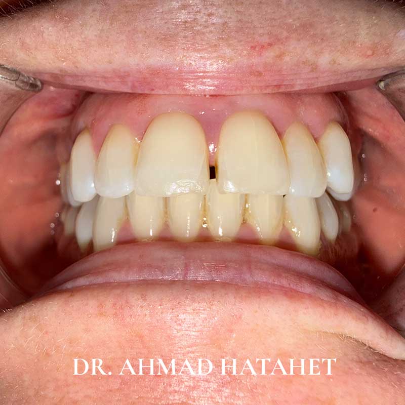 Before dental treatment