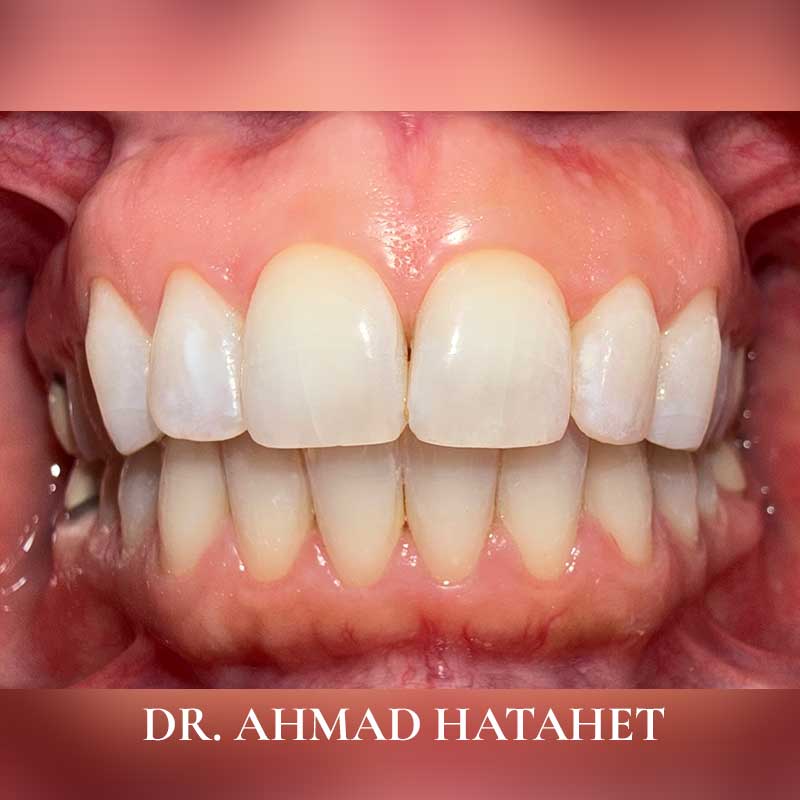 After dental treatment