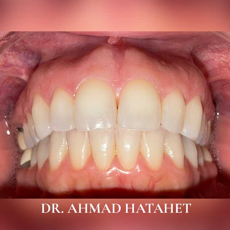 Before dental treatment