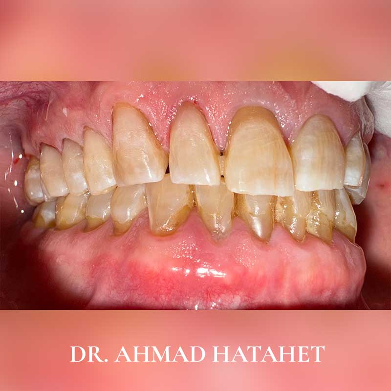 After dental treatment