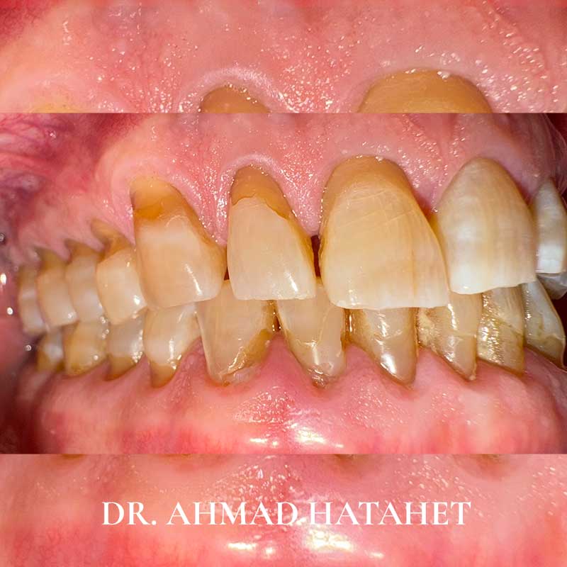 Before dental treatment