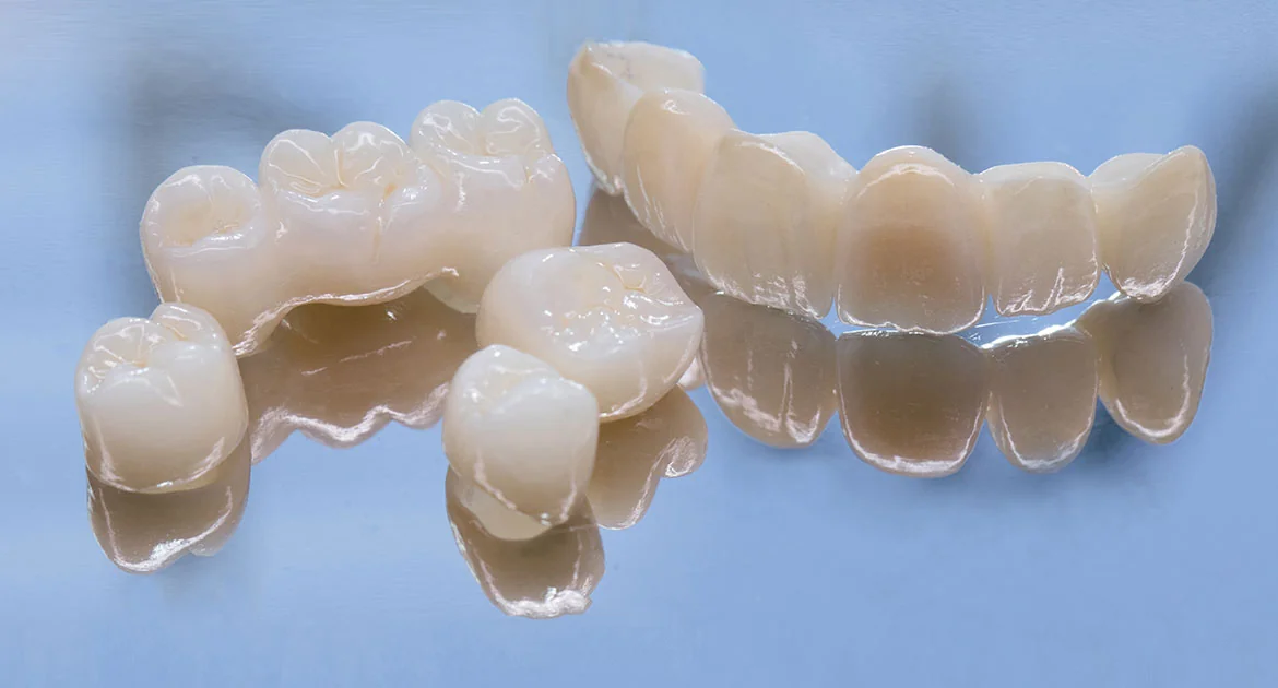 Full Ceramic Crowns at Caring Dental of Herndon