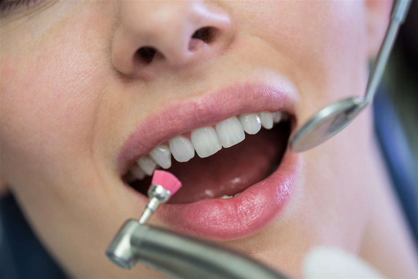 Dental Bonding at Caring Dental of Herndon